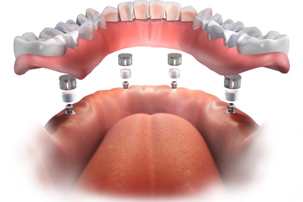 Tips For Cleaning Implant Supported Dentures