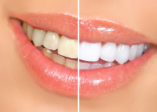 Important Information About Professional Teeth Whitening
